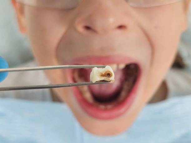 Best Emergency Treatment for Toothache in Caldwell, NJ